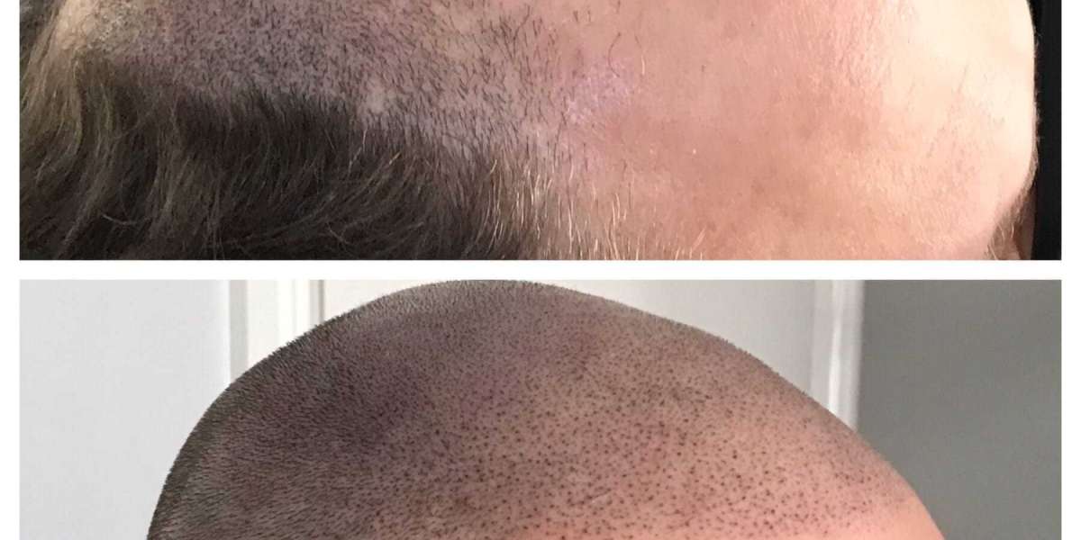 How much does scalp micropigmentation cost