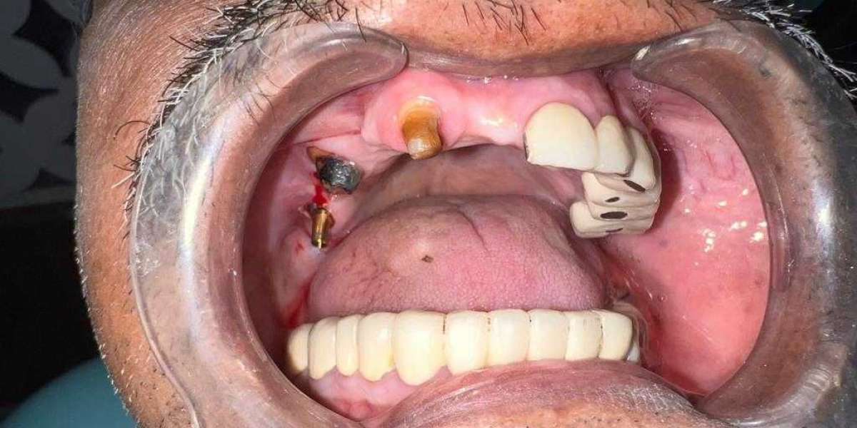 What are good dental implant clinics in Kolkata?
