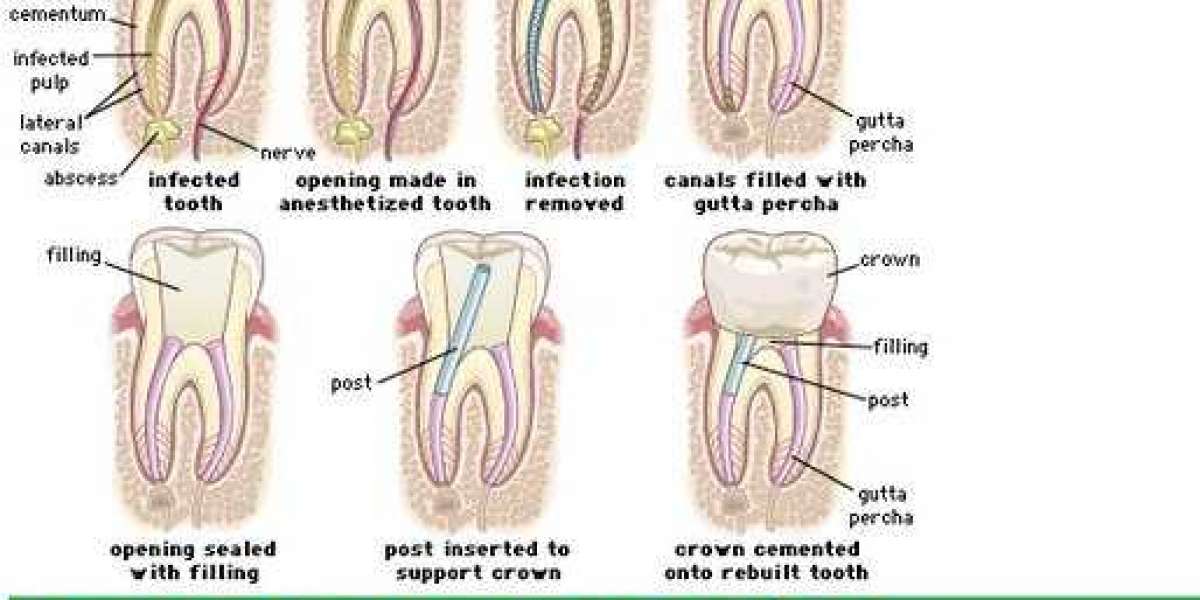 What is the RCT of teeth?