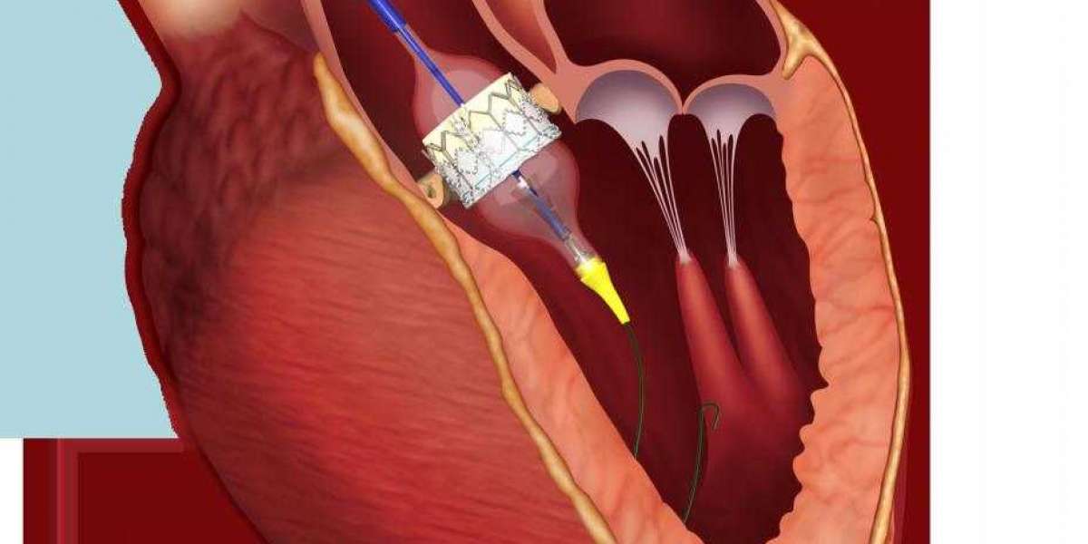 Aortic Valve Replacement Devices Market Will go up Rapidly in 2021-2030 with Top Market Players