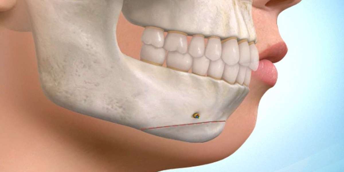 TMJ Implants Market Share Will Continue to Expand Over the Forecast Period 2022-2030
