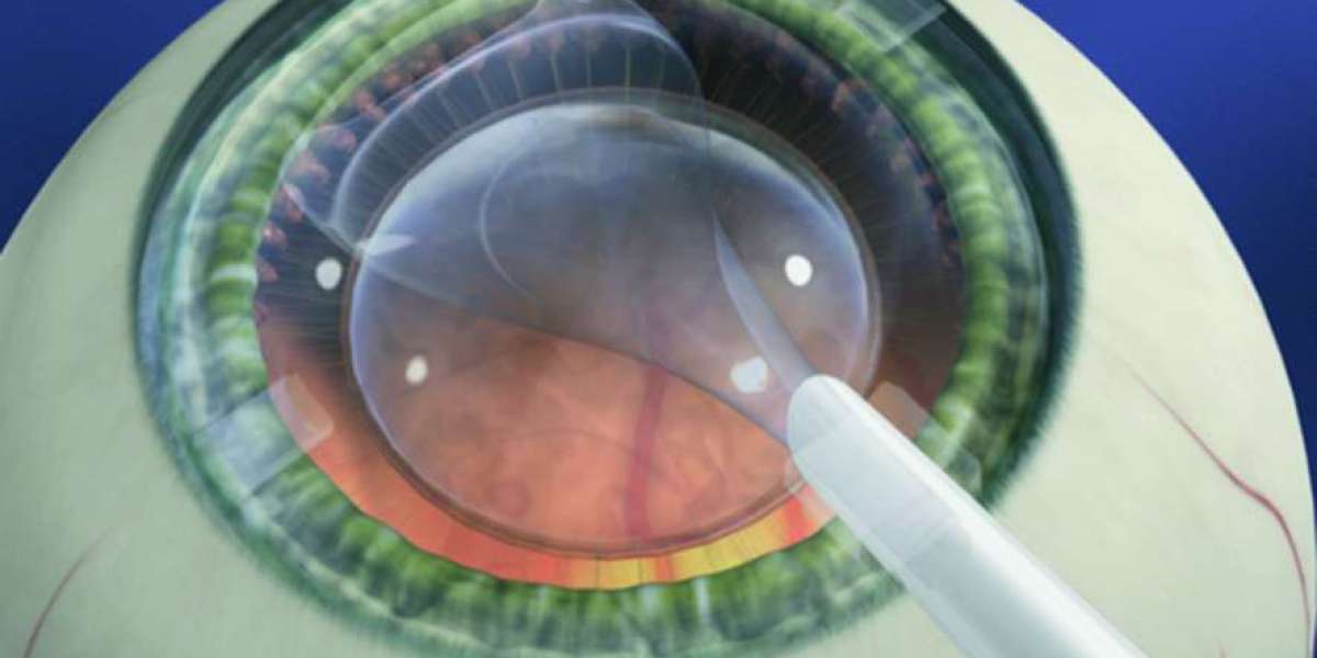 Global Intraocular Lens Market Share Emergence, Insights on Industry Size