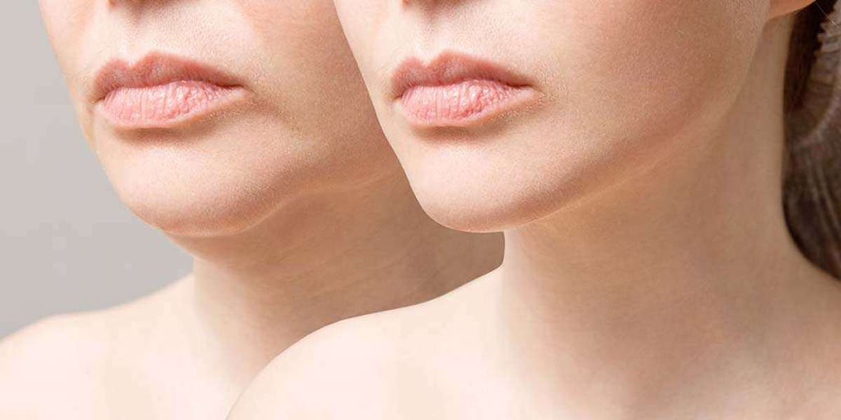 See How Much a Neck Lift Can Help