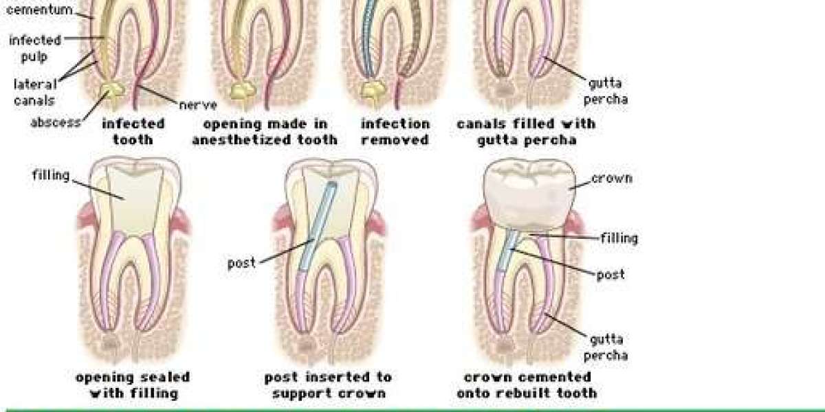 What are root canal treatment steps?