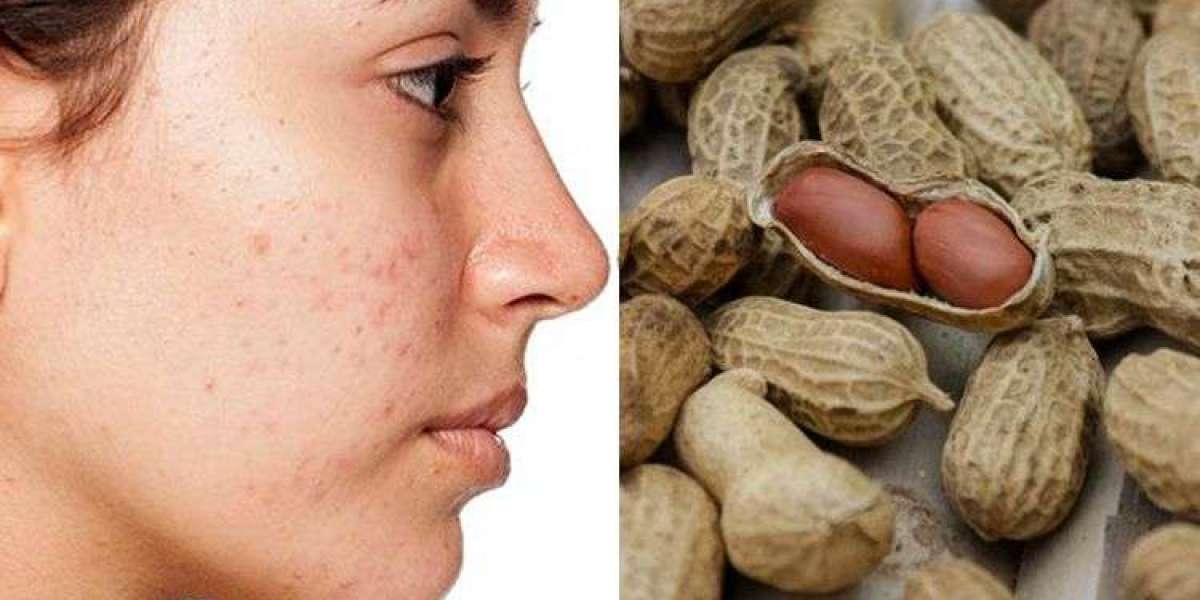 Nut Allergy Therapeutics Market Share and Outlook till 2029