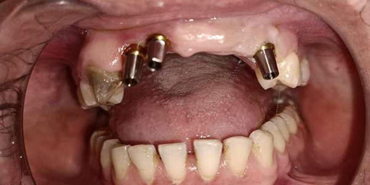 How do you Care for Dental Implants?