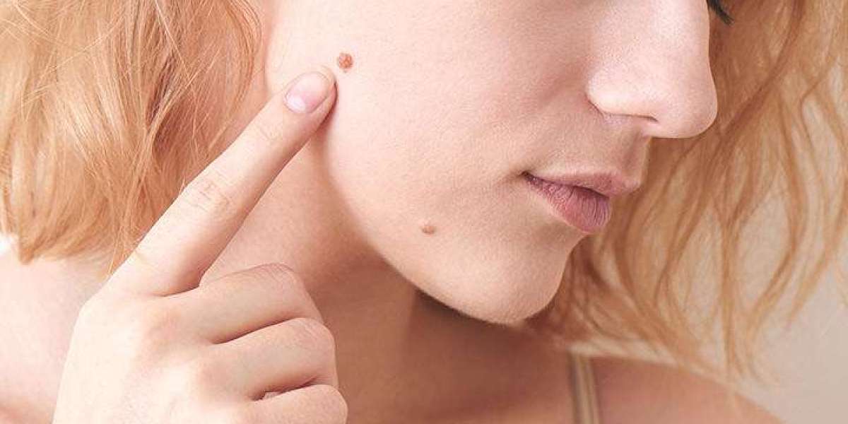How It Defy Skin Tag Remover Work?