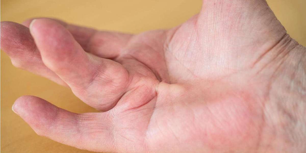 Global Dupuytren’s Contracture Market Share To Expand At A Notable CAGR Of 4.9%