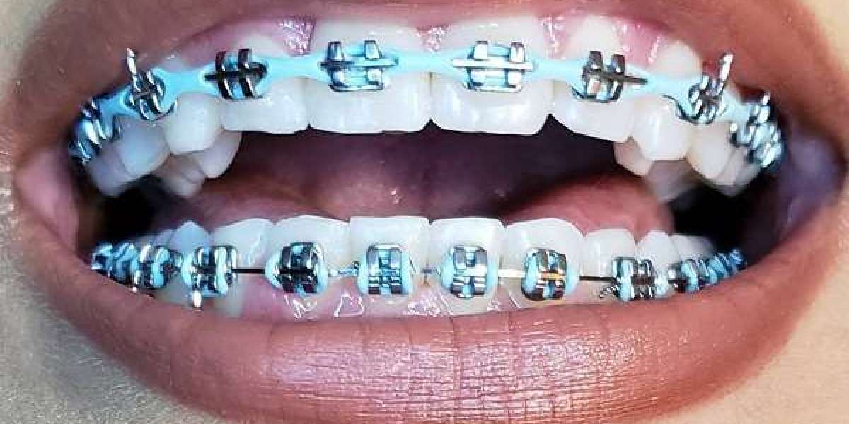 How Do Bite Blocks Help When Wearing Braces to Align Teeth Properly?