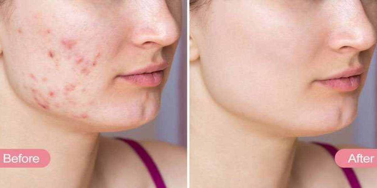 How can I get rid of acne scars?