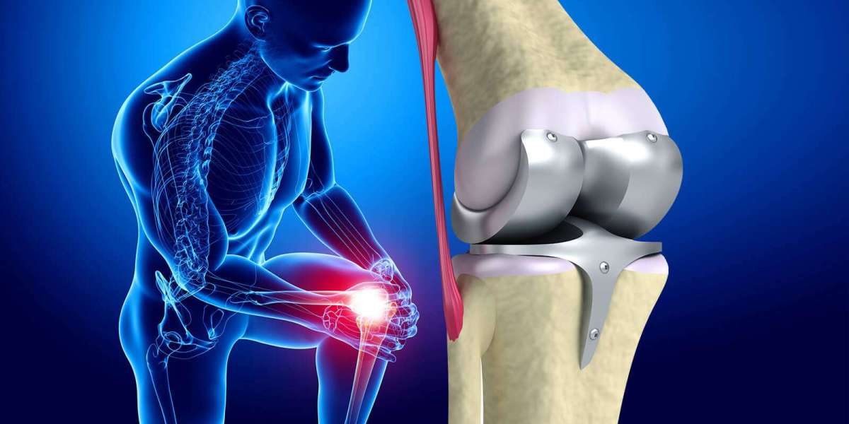 Knee Replacement Market Share Thrives Due to Introduction of New Technologies