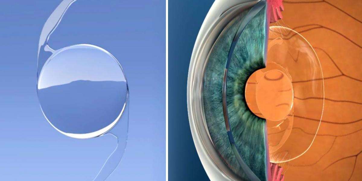Intraocular Lens Market Share is Predicted to Register 5.17% CAGR between 2023-2030
