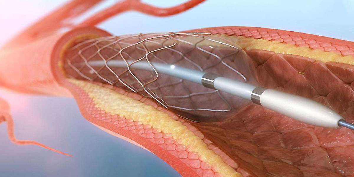 Cerebral Vascular Stent Market Share to Cross USD 378.7 Million Valuation By 2030