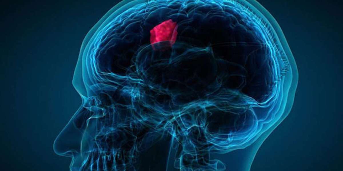 Pediatric Brain Tumor Market Share to Benefit from the Technologically Modern Solutions