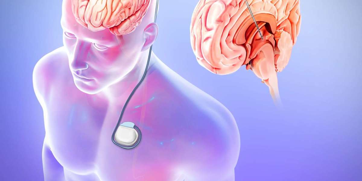Global Epilepsy Surgery Market Share & Upcoming Industry Growth | Report Covers Industry Insights on Regional Compet