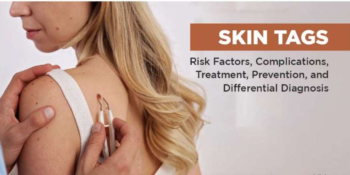 Rejuva Skin Tag Remover: Skin Care Review, Results, Hoax Or Legit?