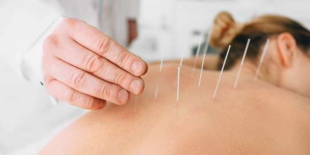 Discover the Healing Benefits of Acupuncture in Morristown