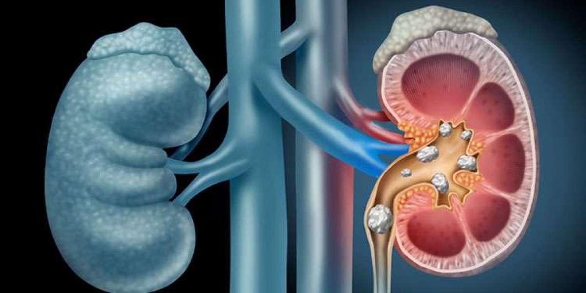 Kidney Stones Management Market 2023 Rising Trends, Demand, Global Opportunity And Outlook