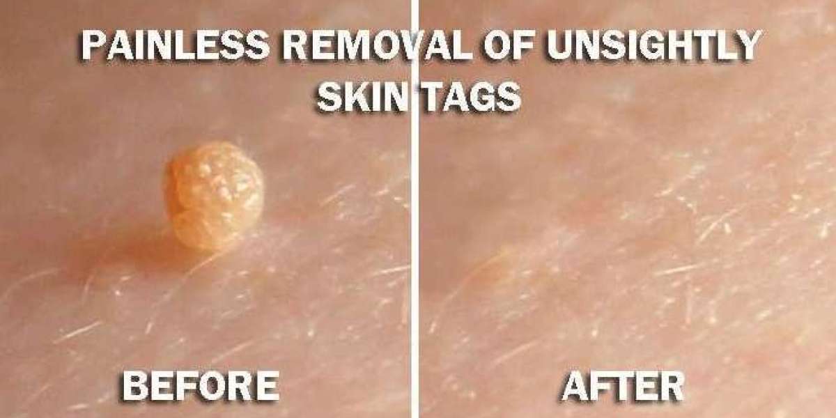 Clean As Teen Skin Tag Remover Reviews