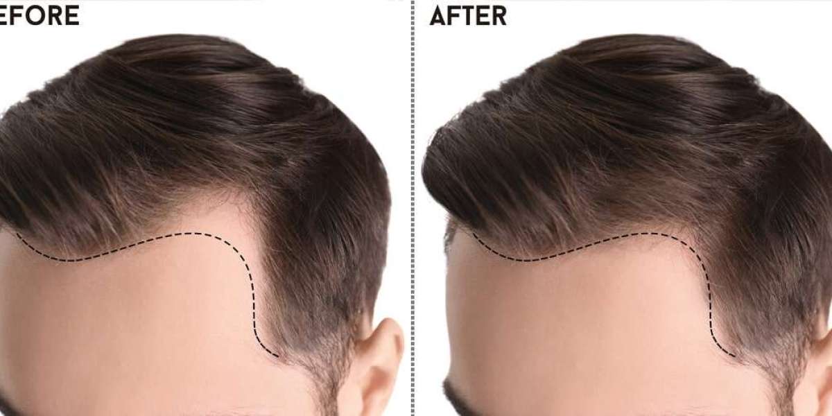 Revive Your Confidence with DHI Hair Transplant in Islamabad