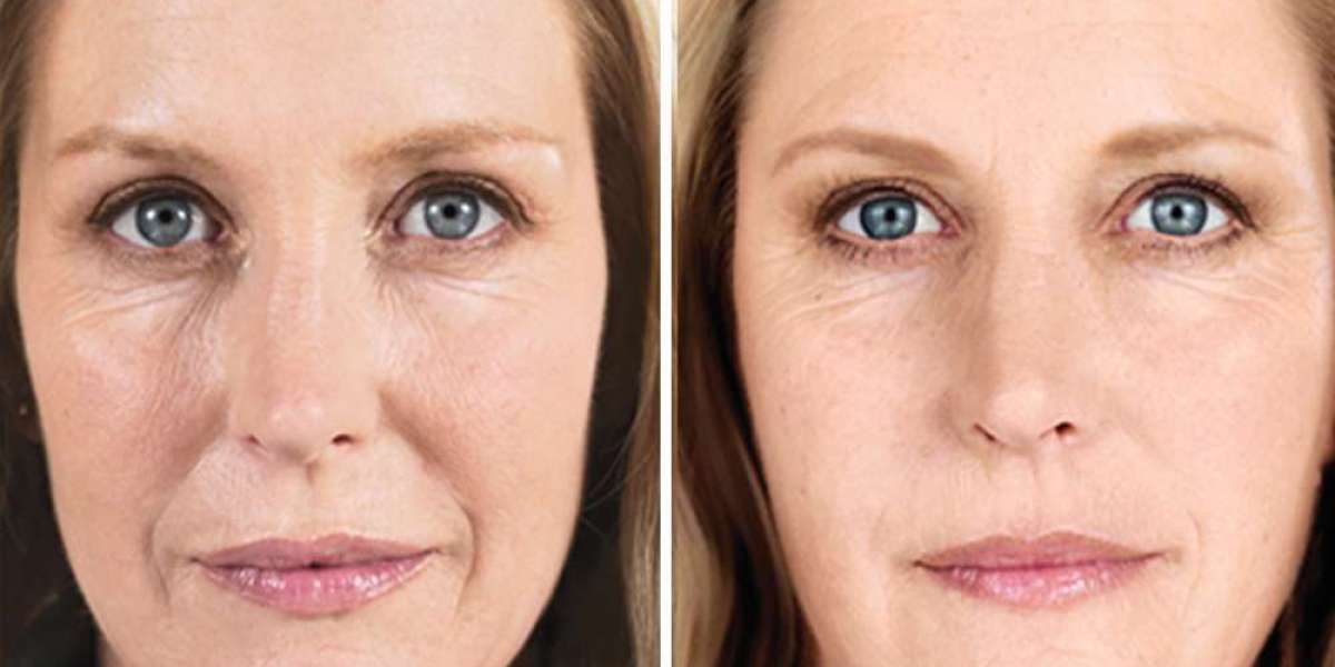 Transforming Your Look: Botox Before and After Eyes