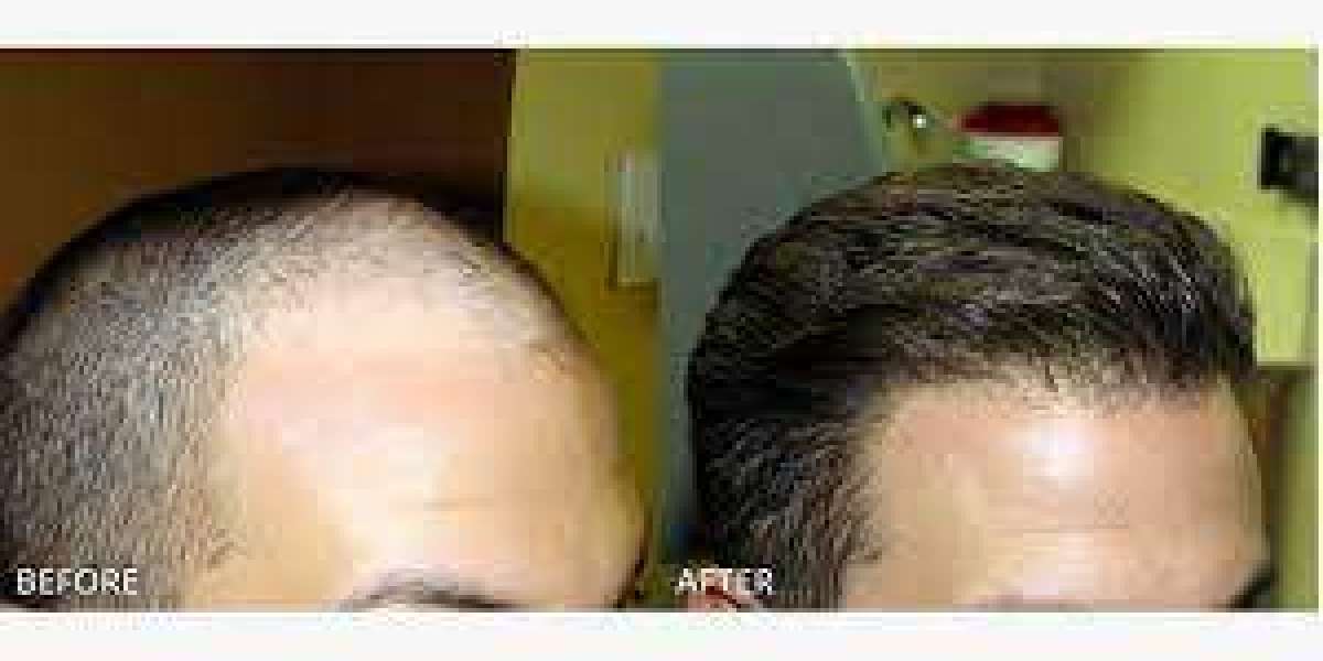 Advances in Stem Cell-Based Therapy for Hair Loss