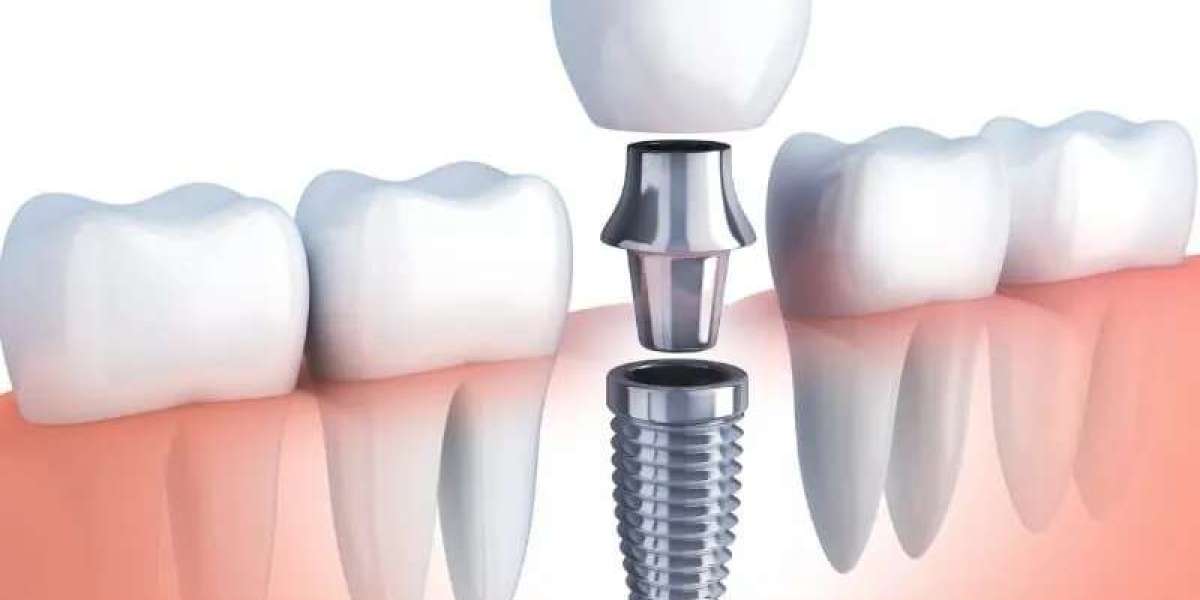 Shielding Smiles: The Importance of Sealants Dental Services in McKinney, TX