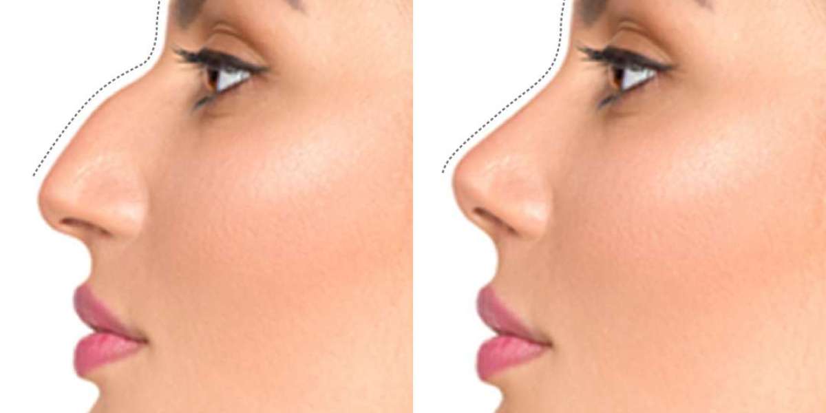 How Augmentation Rhinoplasty Can Make the Nose Look Smaller