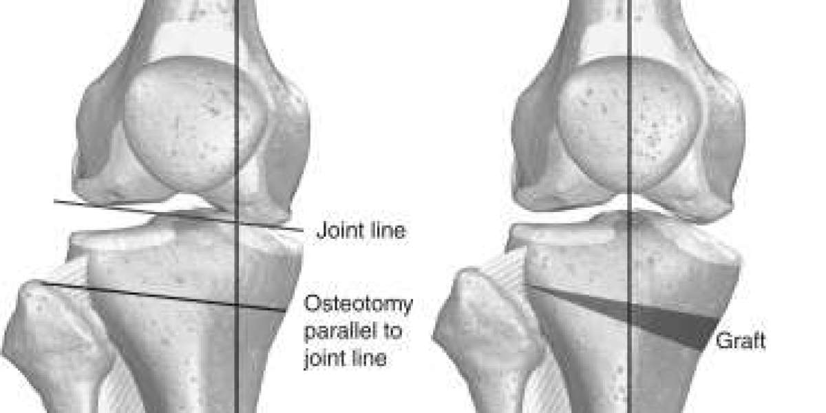 Mastering Knee Surgery: Key Considerations for Selecting the Best HTO Doctor