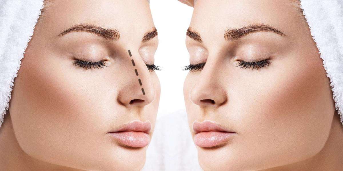 Recovery Process After Rhinoplasty Surgery in Dubai