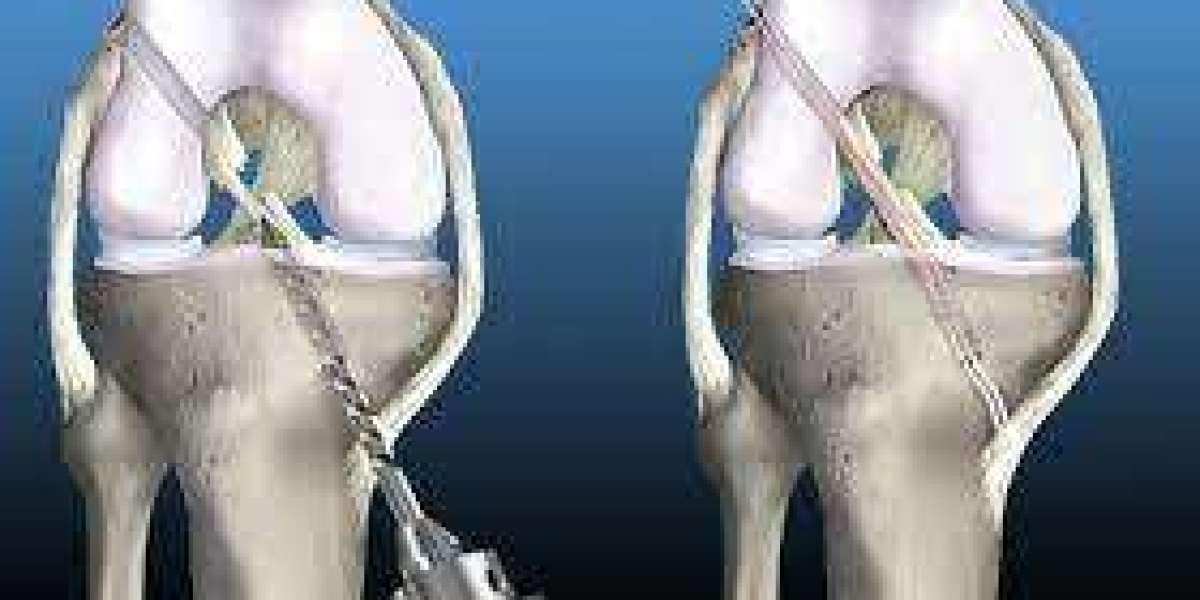 Mastering Mobility: The Vital Role of Knee Replacement Surgeons