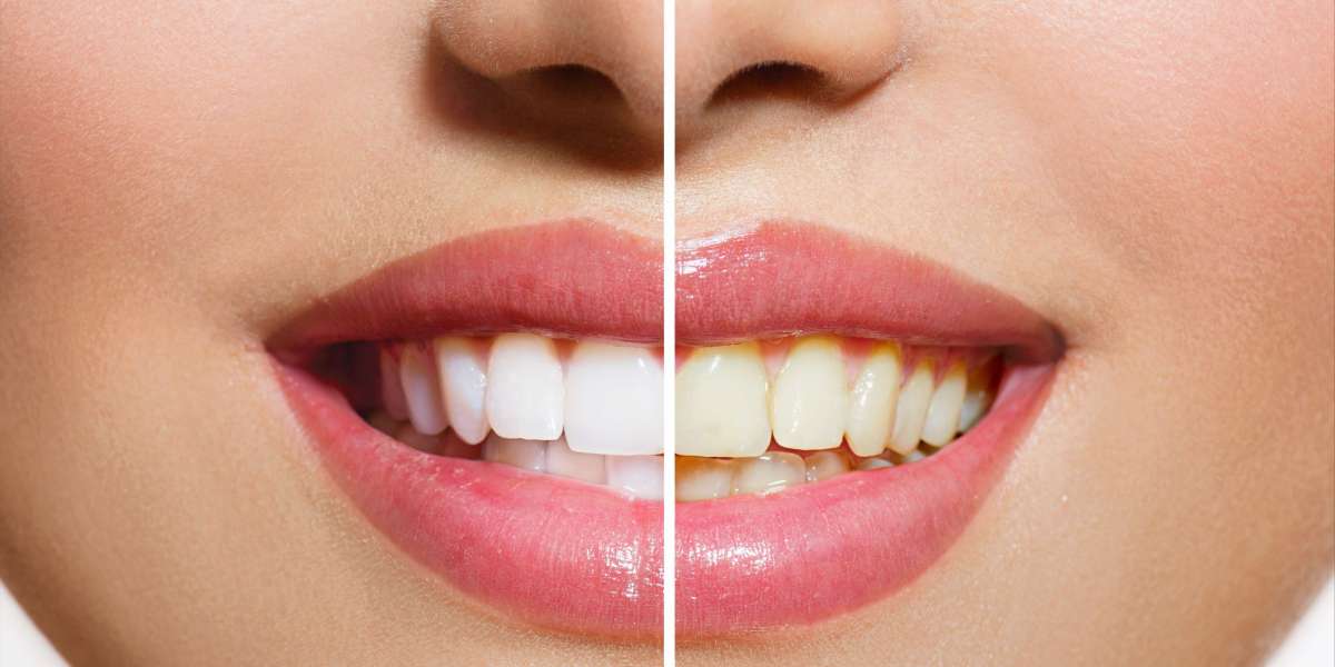 Teeth Whitening Treatment: Apply Online for Better Results And Care