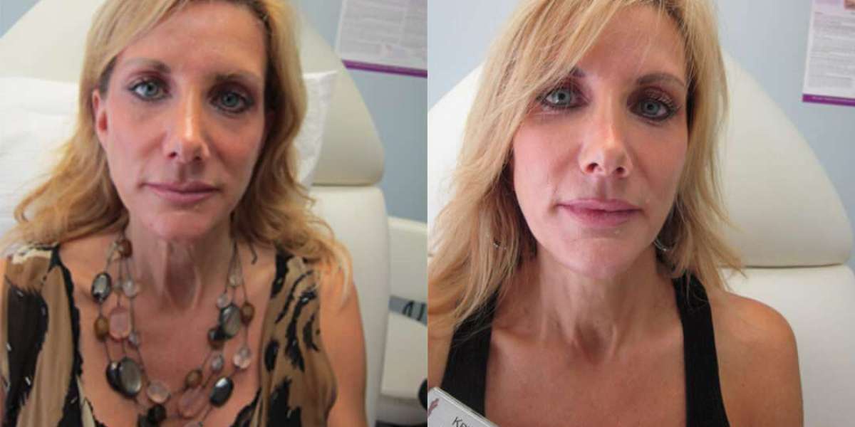 What is the True Cost of Sculptra in Torrance, CA?