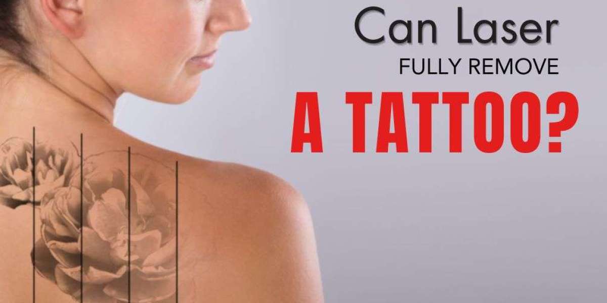 Does Laser completely remove tattoos?