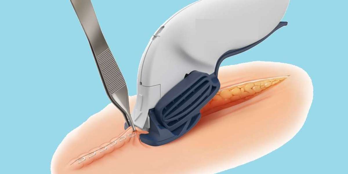 Global Surgical Staplers Market: Research Report on Industry Developments