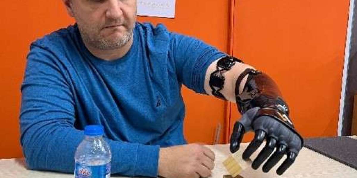 Unveiling the Marvel: The Evolution and Advancements of Bionic Arms