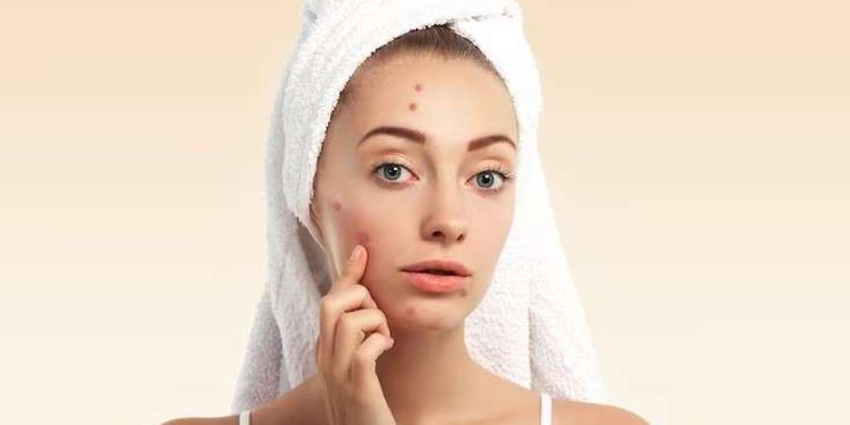 Empower Your Skin: Unveiling Effective Acne Scar Treatment