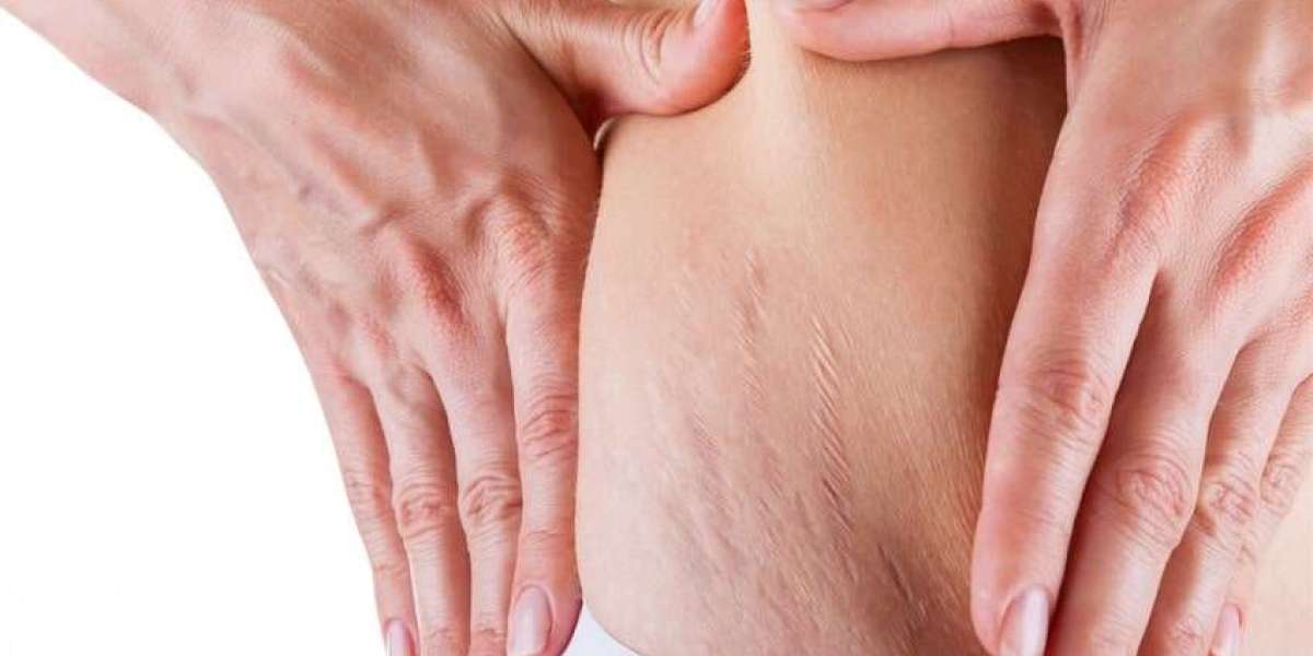 What Does It Mean When Your Stretch Marks Are Itchy?