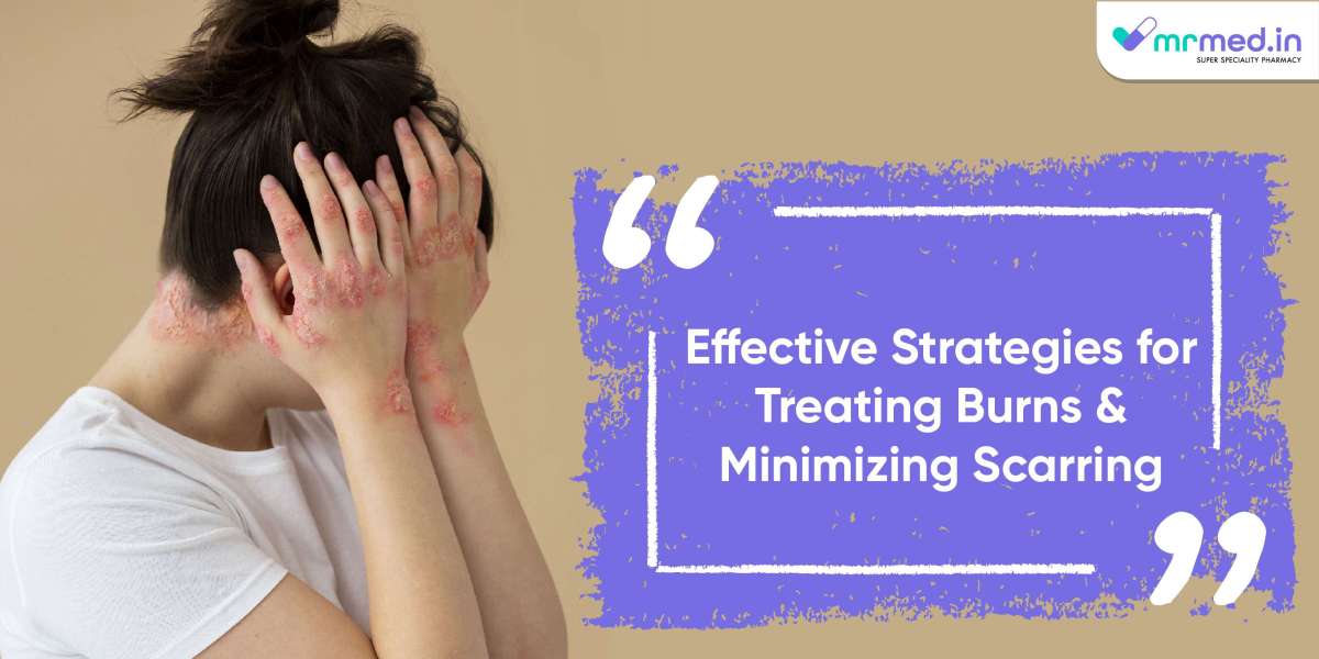 Effective Strategies for Treating Burns and Minimizing Scarring
