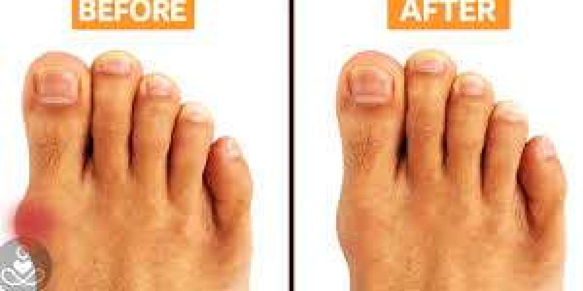 Bunion Surgery Overview Foot Focus Podiatry