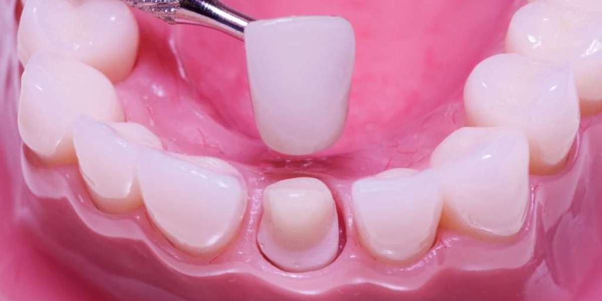 Perfecting Smiles: The Art and Science of Porcelain Crowns in the UK