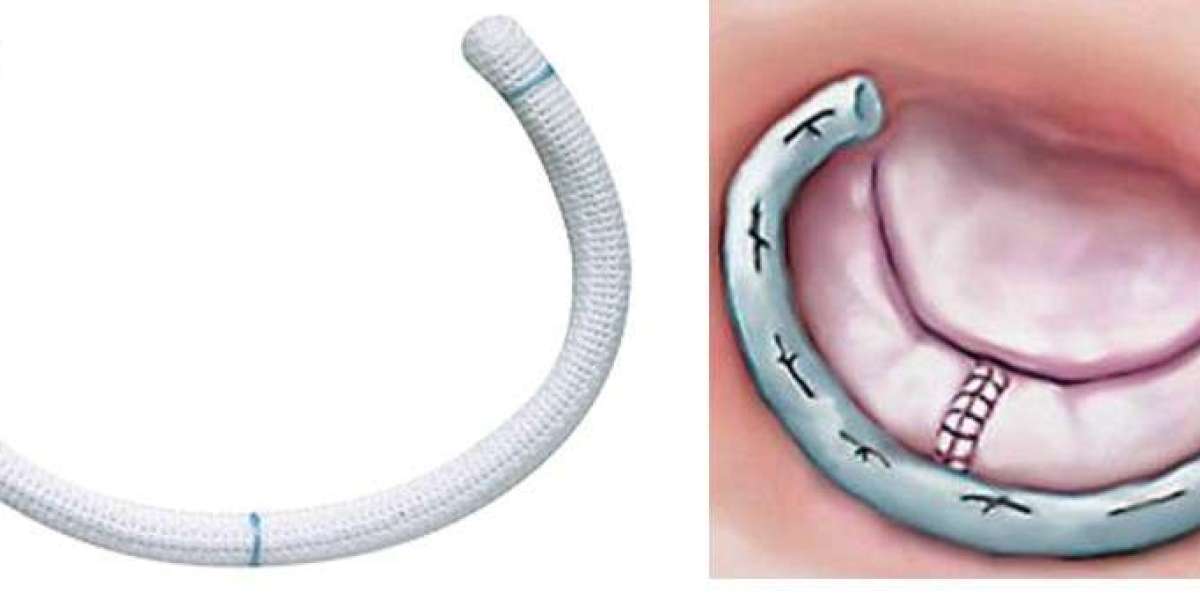 Annuloplasty Rings  Market Size, CAGR,