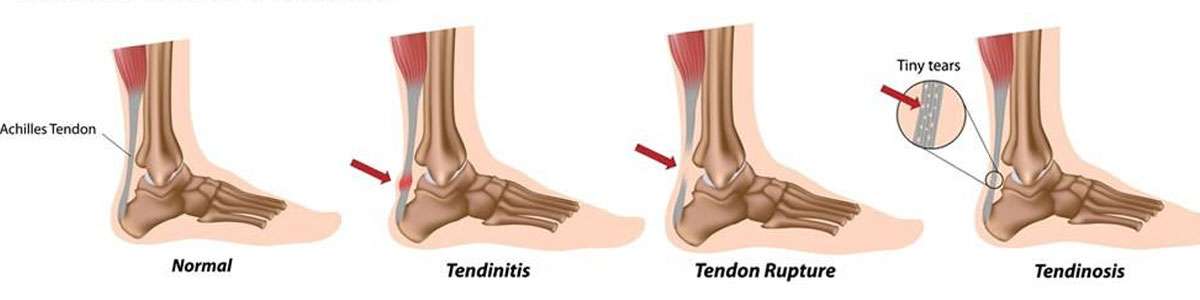 Achilles Tendon Burning Pain Treatment | Achilles Tendonitis