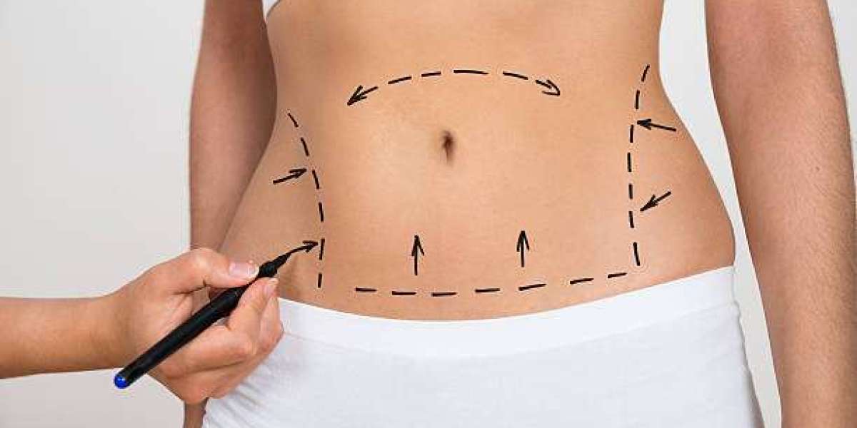 Exploring Liposuction Surgery in Dubai: Procedure and Benefits