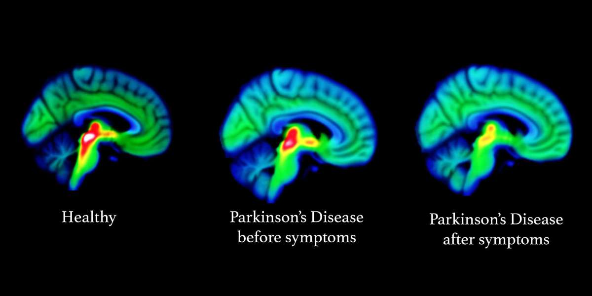 Parkinson’s Disease Therapeutics Market Size, CAGR,