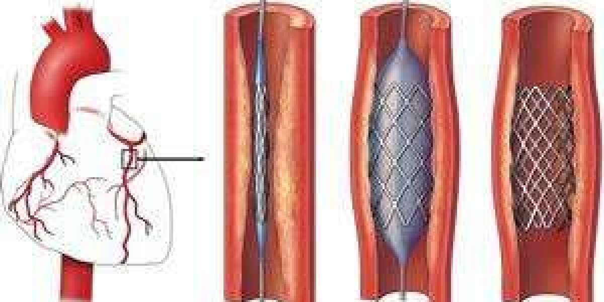 Advanced Carotid Angioplasty: Cutting-Edge Treatment in Delhi