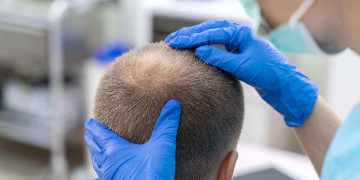 Neoaesthetica Is Your Best Place For The Top Hair Transplant Surgeon In Lucknow