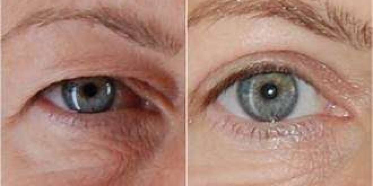 Increasing The Gaze: The particular Defined Information to be able to Blepharoplasty
