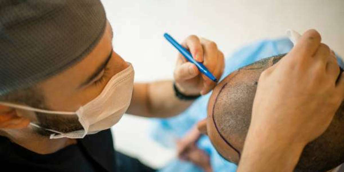 Unveiling the Truth Behind Hair Transplant Cost in Riyadh: Myths vs. Realities