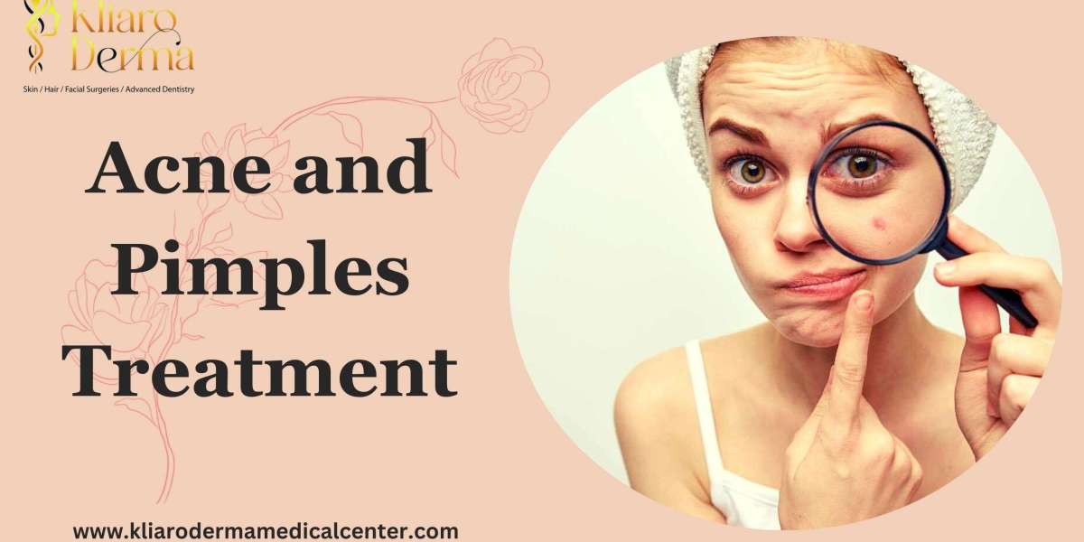 Expert Tips for Choosing the Right Acne Treatment for Your Skin